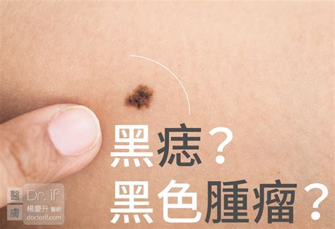 陰囊有痣|陰囊上的痣：是否需要切片檢查和去除？